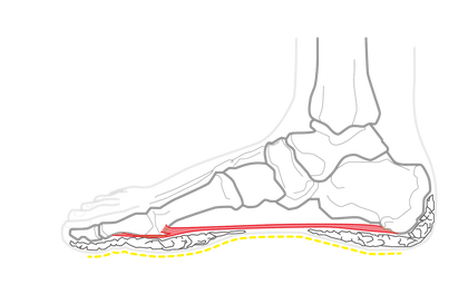Diagram: How feet pain occurs - plantar fascia explained - side view